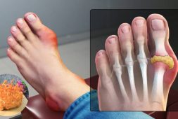 bệnh gout có dùng được đông trùng hạ thảo không