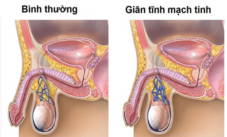 Giãn tĩnh mạch thừng tinh khiến loãng tinh trùng