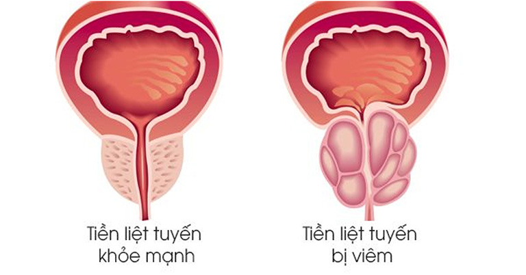 Vón cục tinh trùng do bệnh lý nam khoa như viêm tiền liệt tuyến