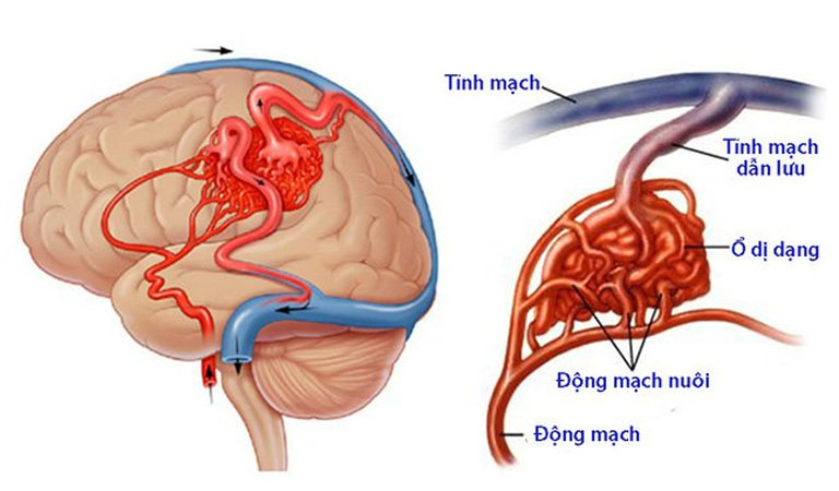 Bệnh có thể do mạch máu dị dạng