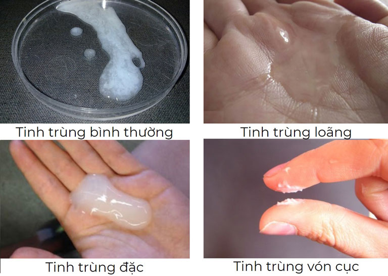 Phân biệt tinh trùng bình thường và các tình trạng lỏng, đặc, vón cục