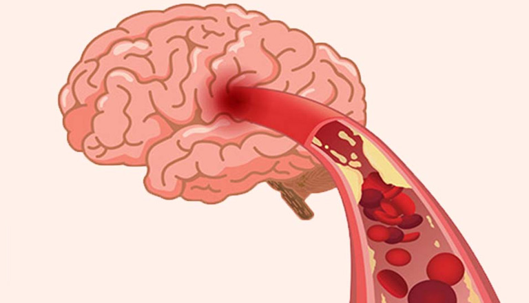 Bệnh có thể khởi phát do thiểu năng tuần hoàn não