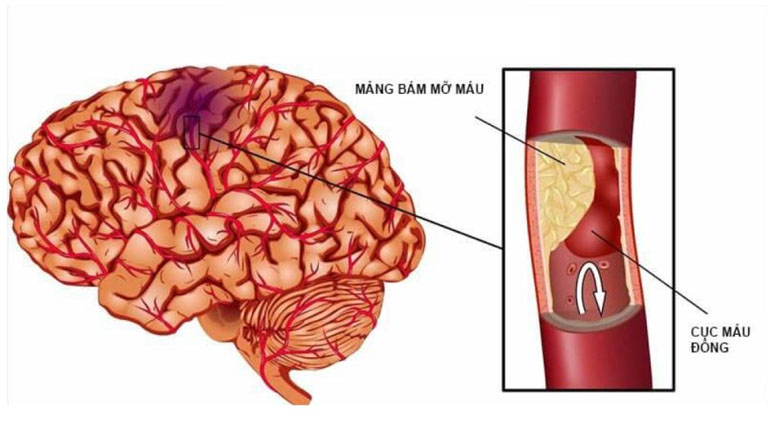 đau đầu khi ngủ dậy